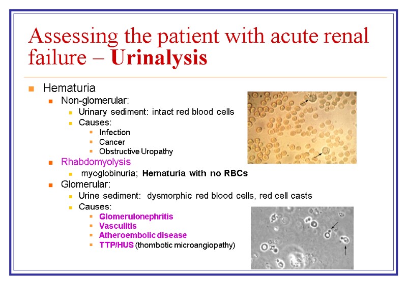 Assessing the patient with acute renal failure – Urinalysis Hematuria Non-glomerular: Urinary sediment: intact